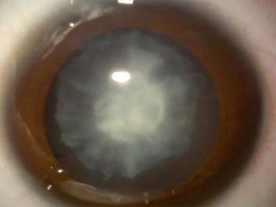 匐行性角膜溃疡黑眼球有一大片白斑图.jpg