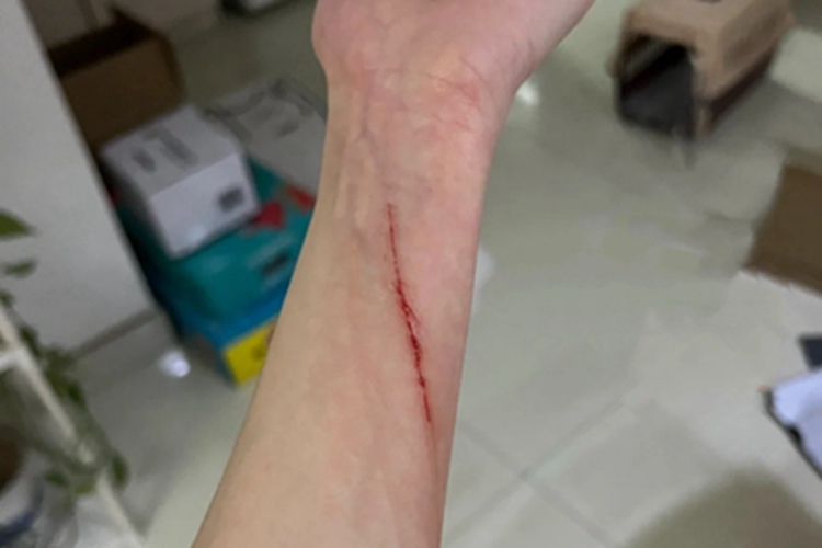 抓伤胳膊裂口图