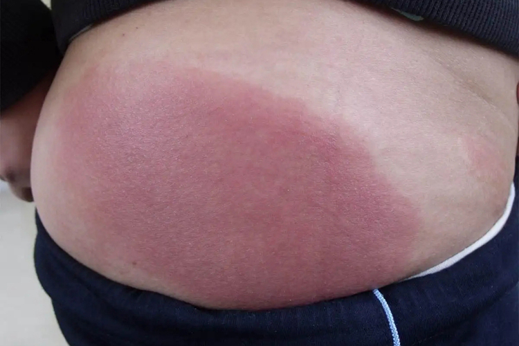 胯部亚急性触性皮炎图 胯部亚急性触性皮炎图