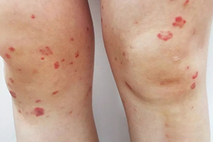 皮肤小血管炎小红疙瘩图 皮肤小血管炎小红疙瘩图