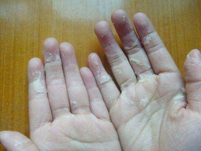 急性维生素A过多症手指大块脱皮图.jpg