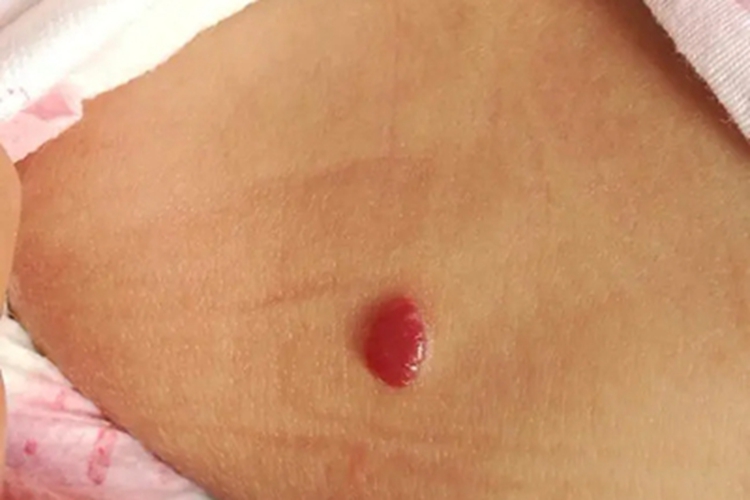 樱桃状血管瘤腰部症状图