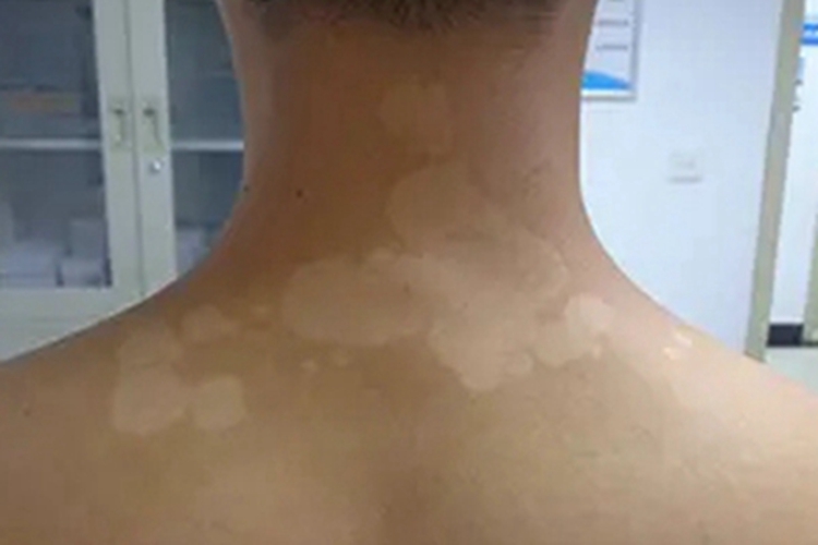无色素痣颈部症状图 无色素痣颈部症状图