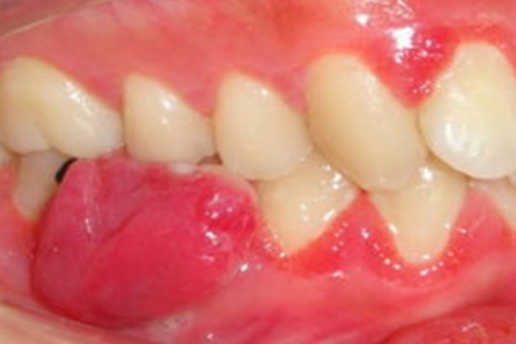 妊娠期龈瘤牙龈症状图