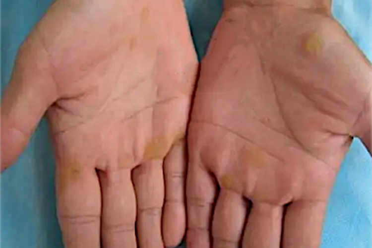 点状掌跖角皮症手掌硬块图