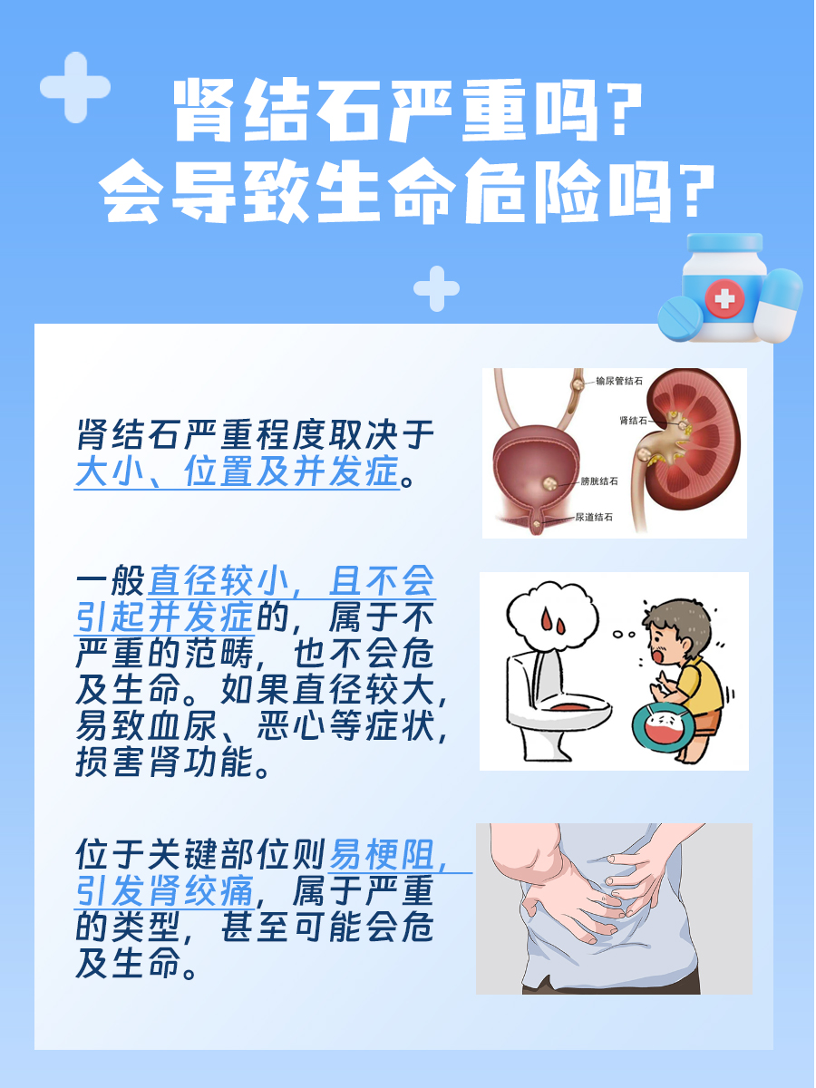 肾结石警报！严重度揭秘，会致命吗？