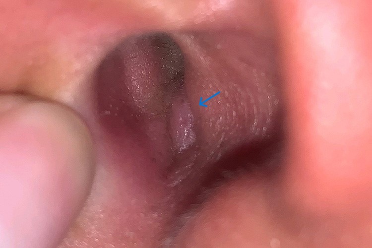 耳朵里外耳道疖肿图 耳朵里外耳道疖肿图