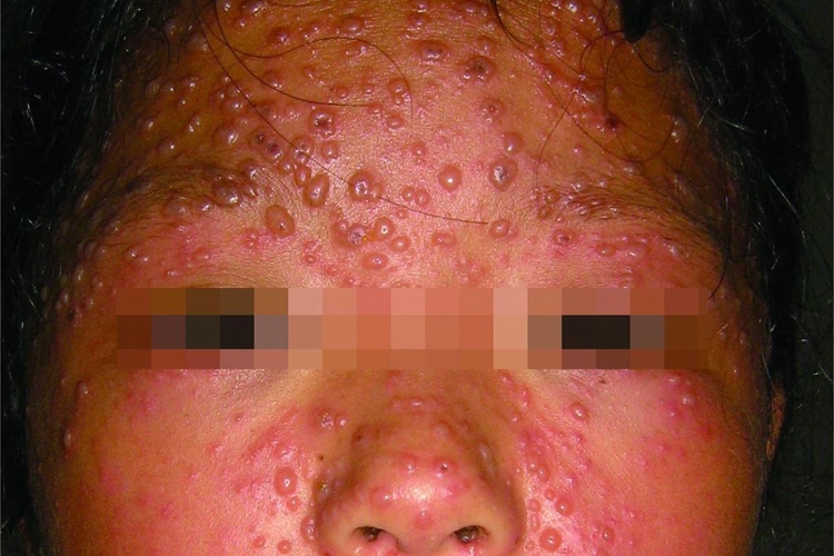 卡波西水痘样疹丘疹图