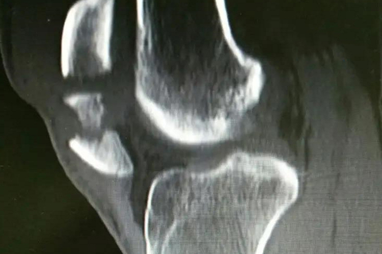 髌骨下极撕脱性骨折图 髌骨下极撕脱性骨折图