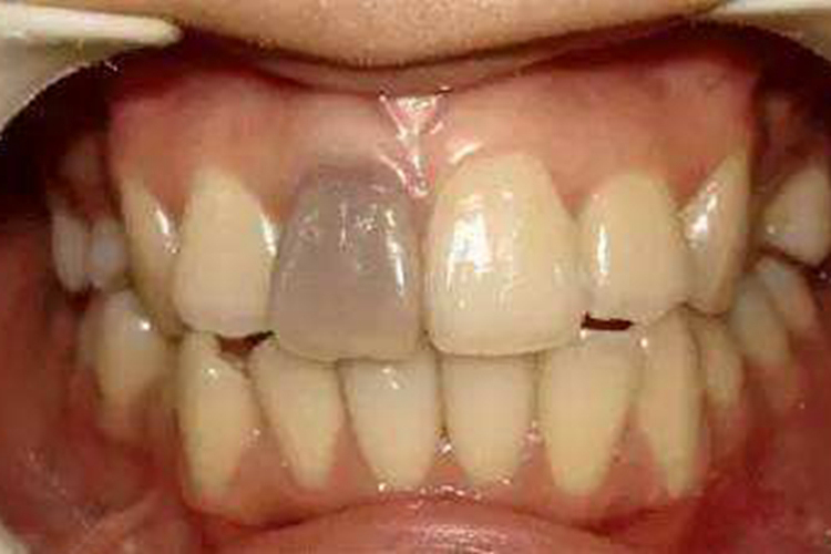 门牙根管治疗后牙齿变黑图 门牙根管治疗后牙齿变黑图