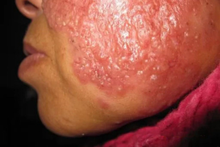 寻常狼疮面部红斑上有结节图