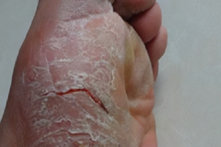 更年期角皮症脚部症状图