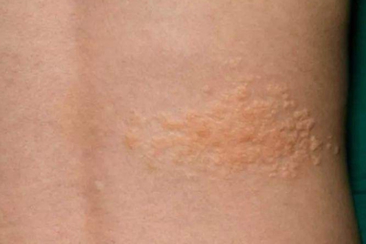 结缔组织痣腰部症状图 结缔组织痣腰部症状图