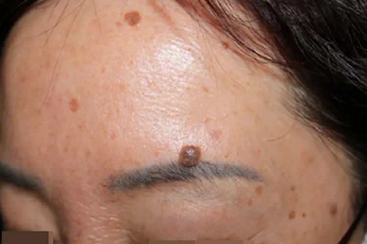 疣状脂溢性角化症斑图