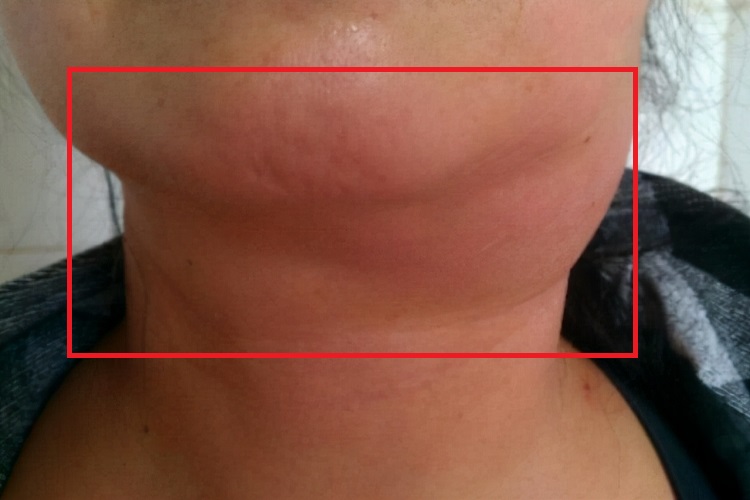 急性颌下腺炎下巴症状图