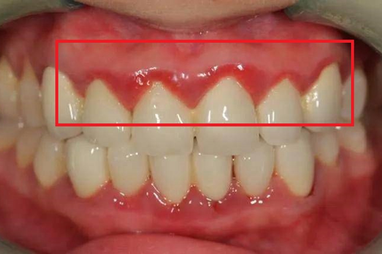 急性坏死性溃疡性龈炎溃疡图 急性坏死性溃疡性龈炎溃疡图