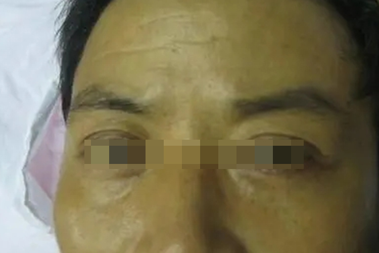 肠癌脸上黄染图