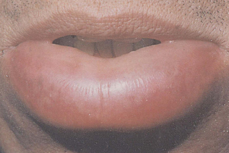 肉芽肿性唇炎图片