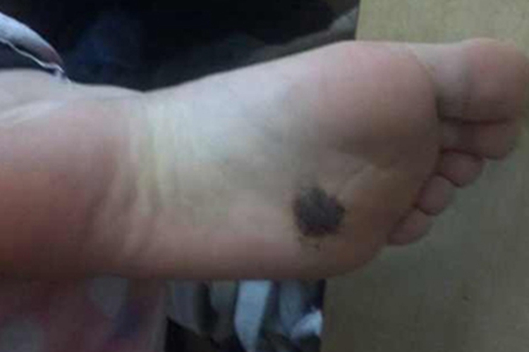 皮内痣脚底症状图