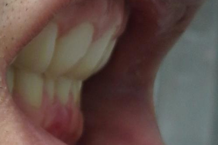 上颌前牙内倾图