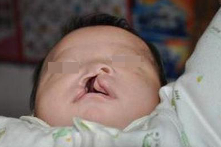 唇腭裂上嘴唇完全裂开萎缩图 唇腭裂上嘴唇完全裂开萎缩图