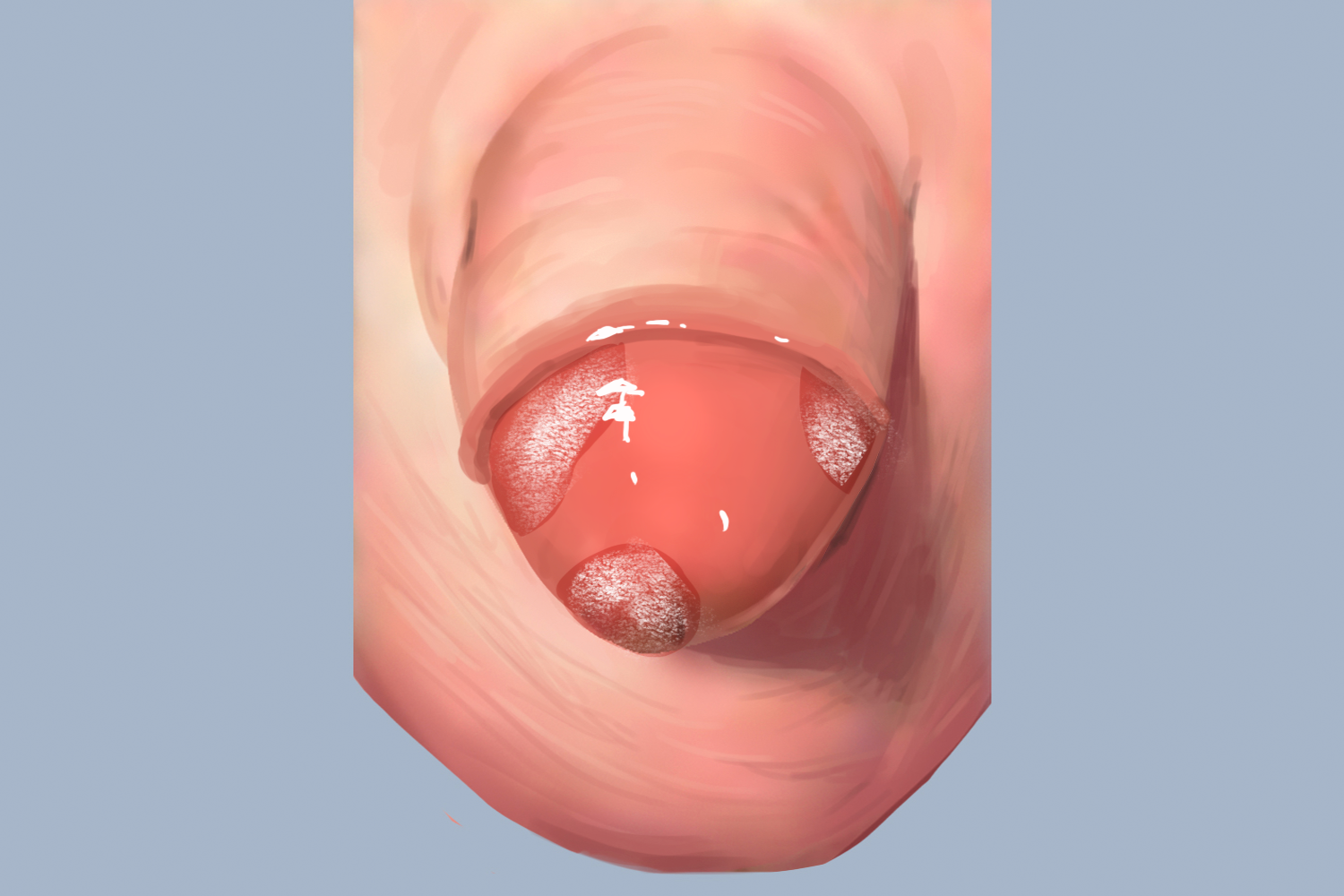 红斑增生病症状图