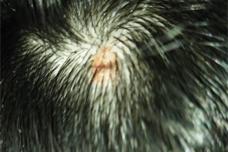 疣状角化不良瘤头皮结节图 疣状角化不良瘤头皮结节图