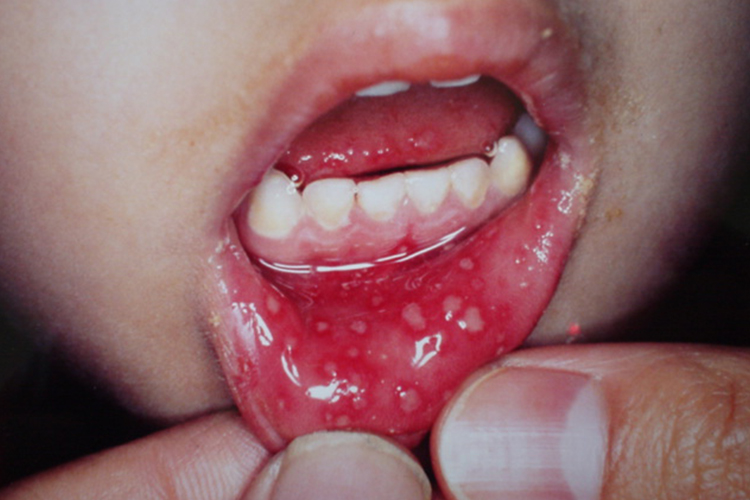 疱疹性龈口炎图