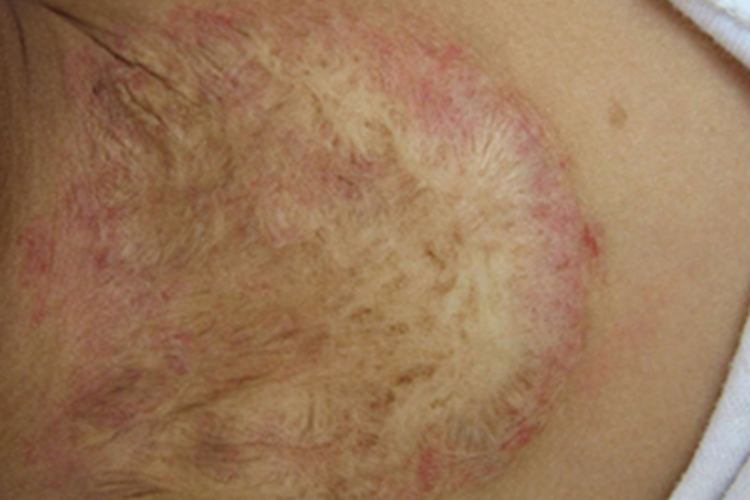 慢性放射性皮炎颈部皮肤萎缩图