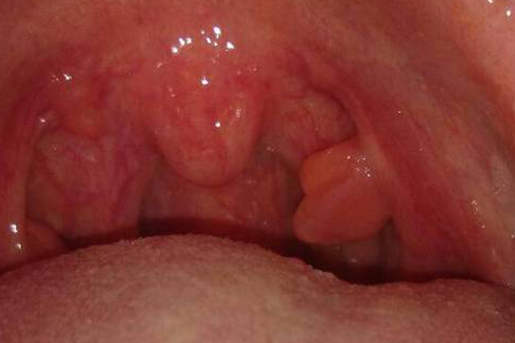 扁桃体息肉图