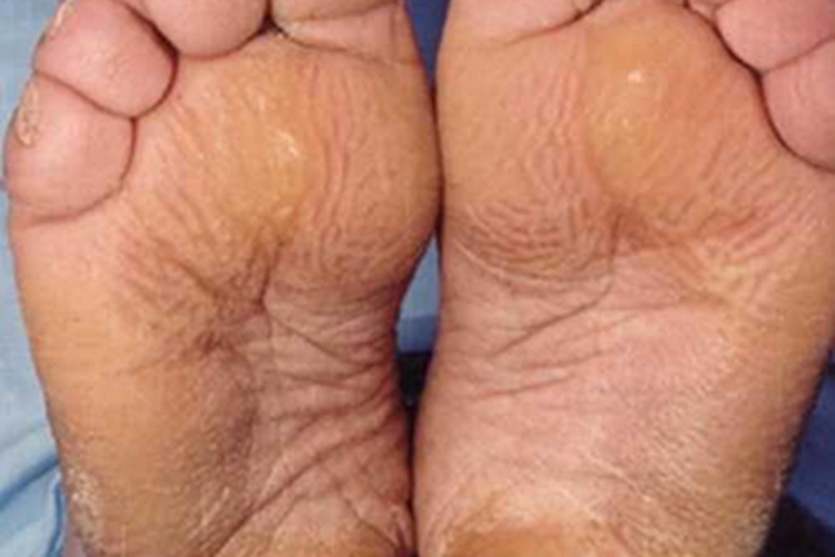 原发性骨膜增生厚皮症皮肤增厚图