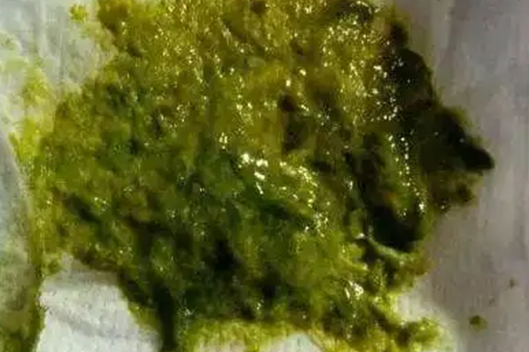 新生儿橄榄绿色糊状大便图