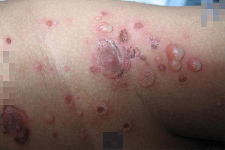 角层下脓疱性皮病腹部症状图