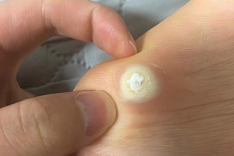 胼胝脚部症状图