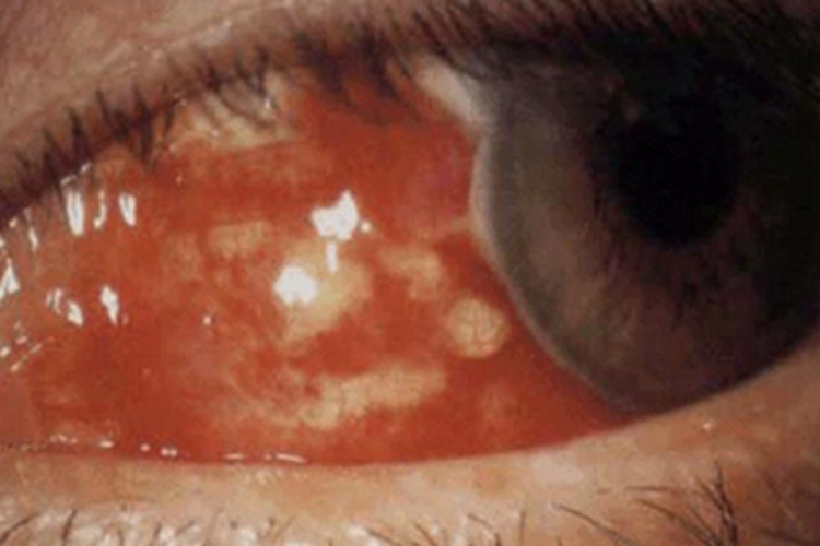 坏死性前巩膜炎症状图 坏死性前巩膜炎症状图