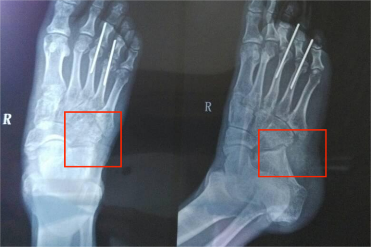 右骰骨撕裂性骨折X线图 右骰骨撕裂性骨折X线图