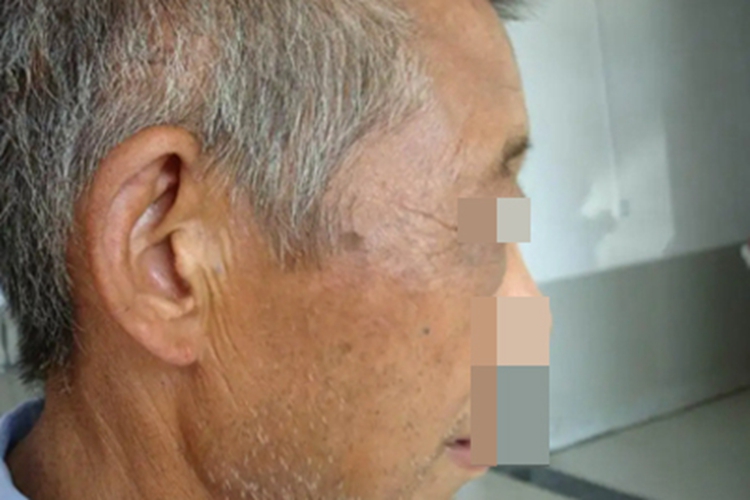 皮肤黑变病右侧脸发黑图 皮肤黑变病右侧脸发黑图