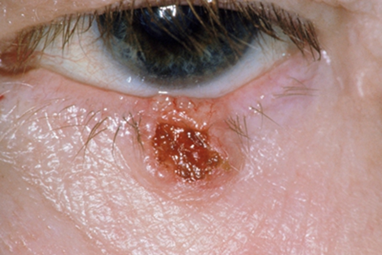 眼睑皮脂腺癌眼睑溃疡图