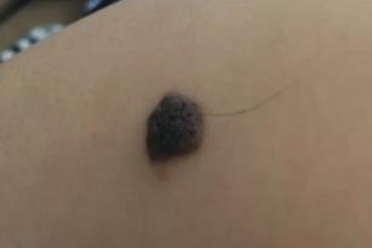 黑素细胞痣黑色肉粒图
