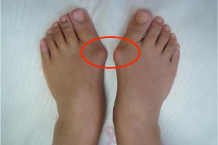 拇趾滑囊炎脚趾硬包图