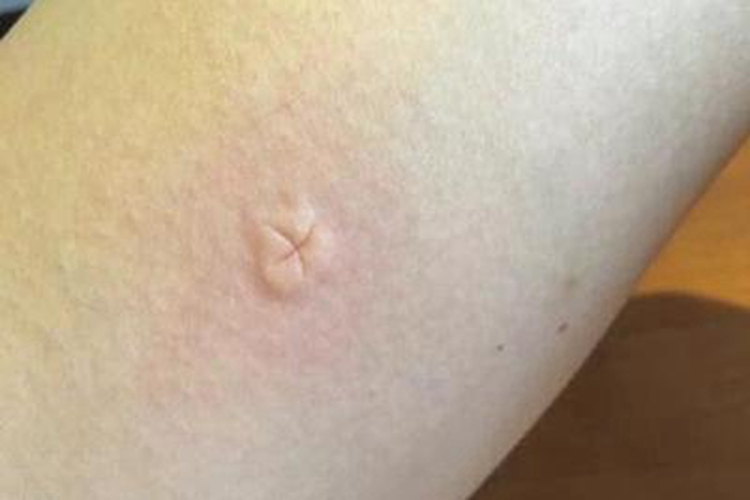 蚊子叮咬腿上有个疙瘩图