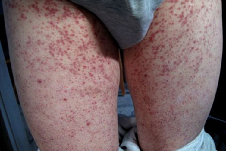 脓毒败血症疹红点图