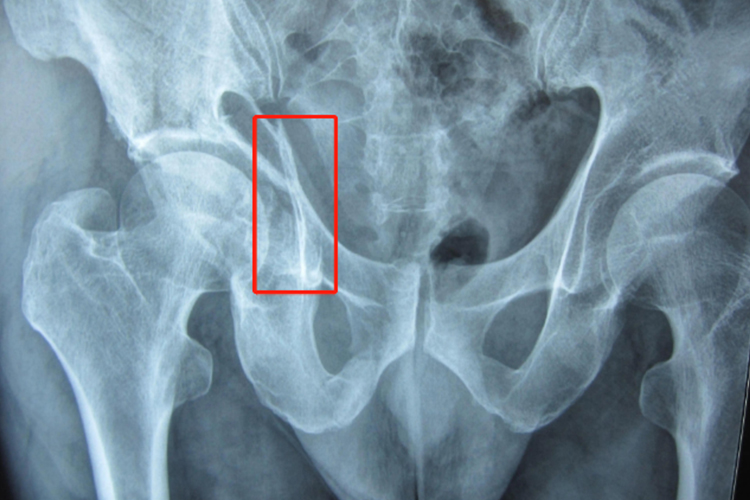 髋臼骨折影像图