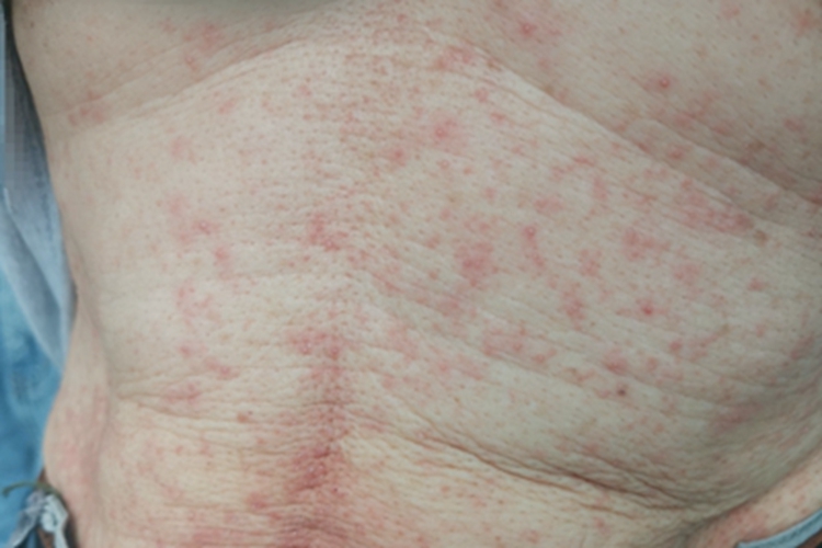 过敏性皮炎腹部疙瘩图