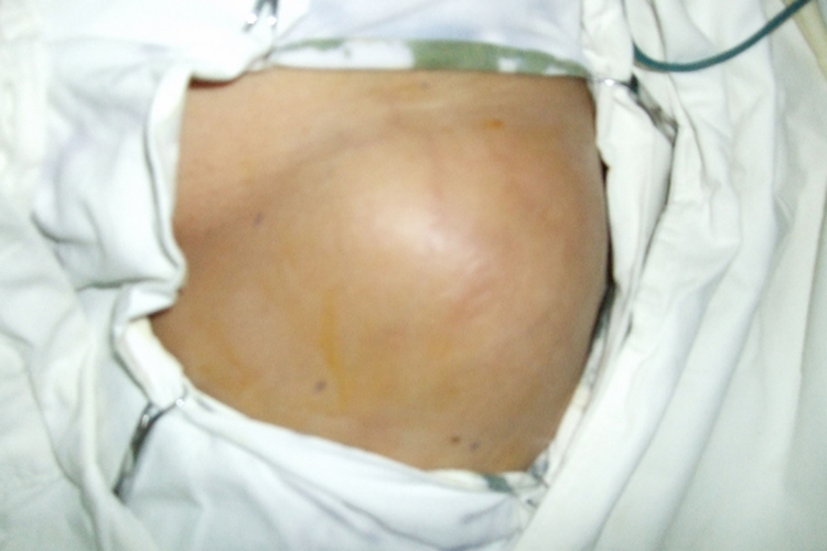 小儿腹股沟斜疝图