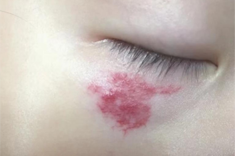 蔓状血管瘤眼周症状图 蔓状血管瘤眼周症状图