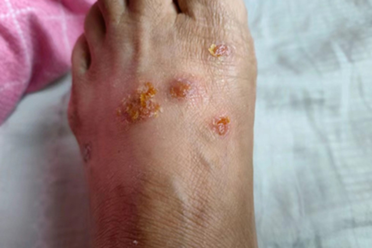 非大疱型脓疱疮脚背黄痂图 非大疱型脓疱疮脚背黄痂图