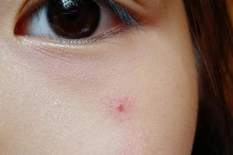 脸上毛细血管型血管瘤图