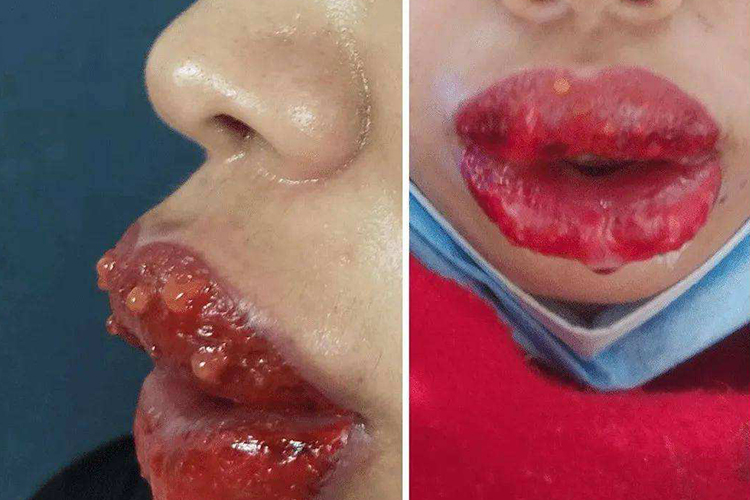 唇部肿胀有水疱图