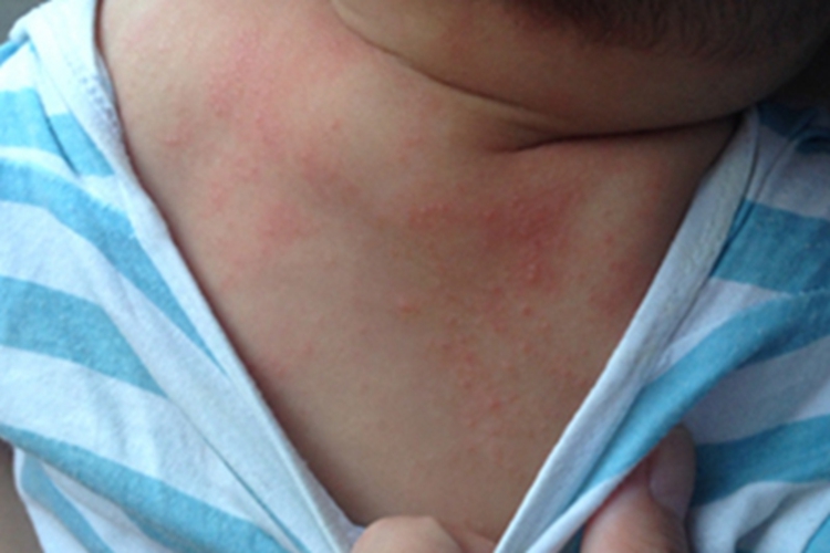 典型麻疹出疹期背部红斑图